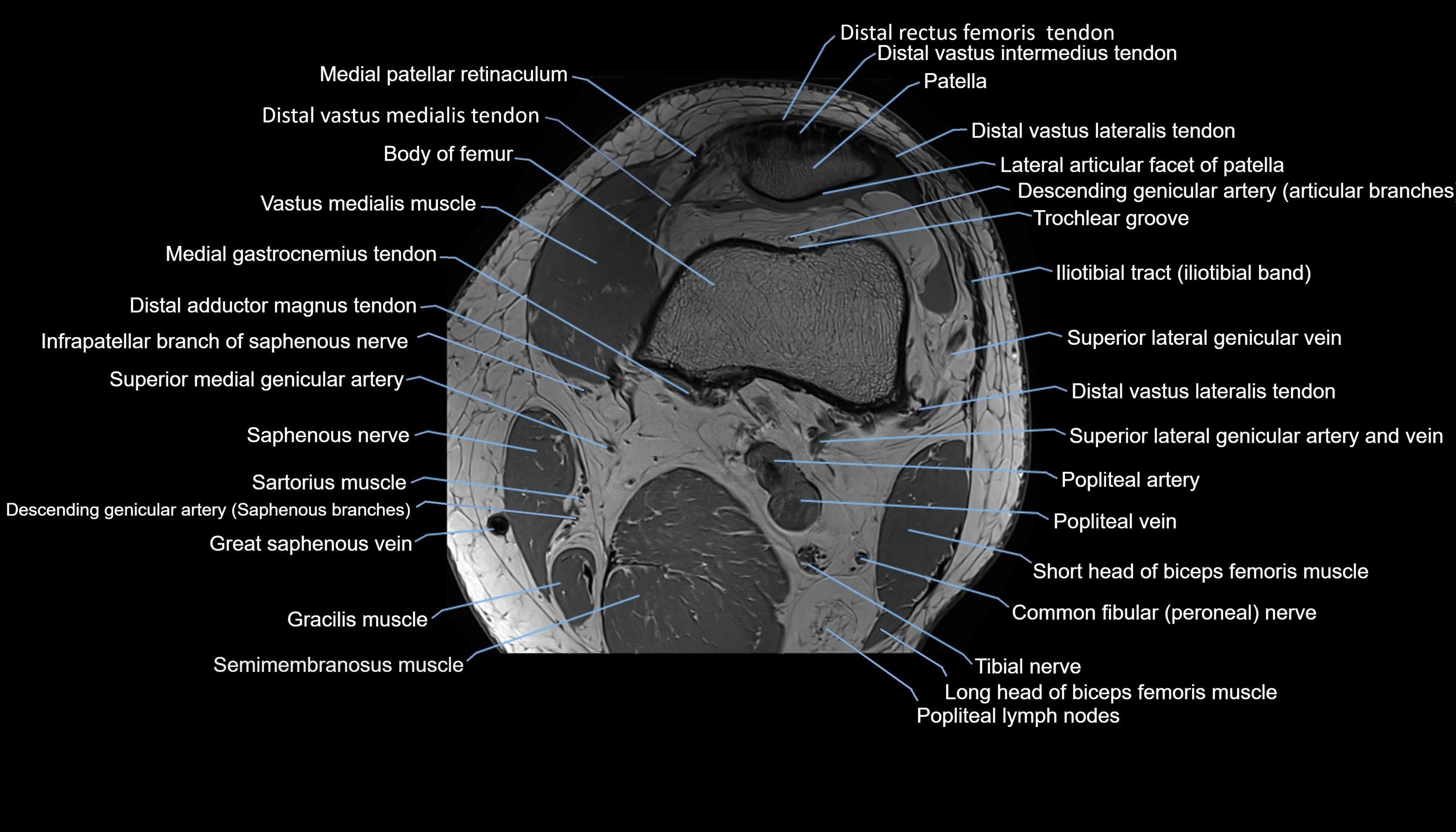 MRI knee  axial cross sectional anatomy 3T radiology  image-img-00001-00009.webp